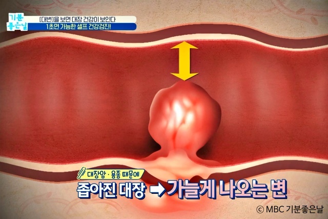 40대 50대 대변색 대변굵기 대장암