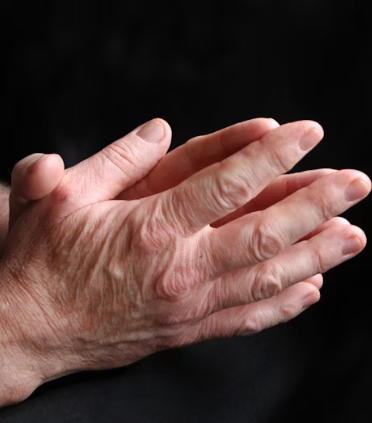 퇴행성 관절염 치료제 예방법 진단기준