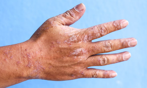 손바닥 껍질이 벗겨지는 이유