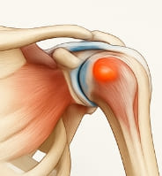 어깨 석회질 치료방법