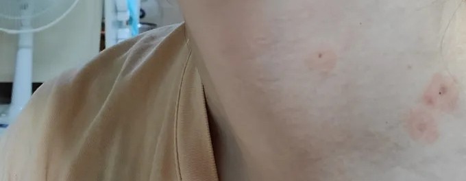 점 제거 후 관리