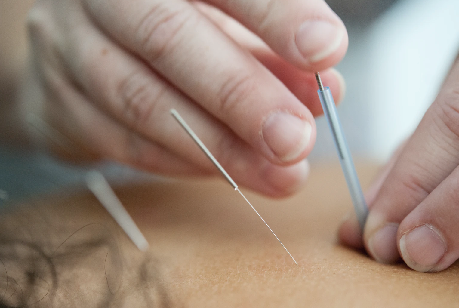 전통의학. 침치료 역류성 식도염치료 사진