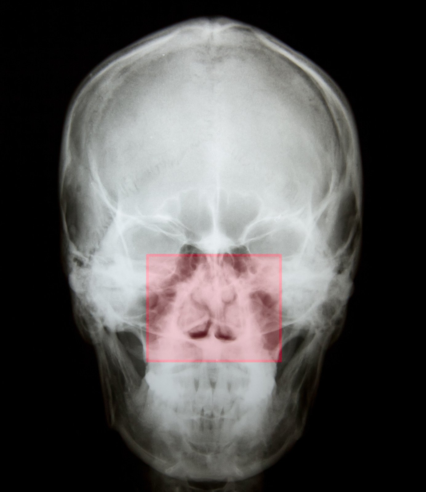 비중격 성형술(Septoplasty): 비중격 만곡 교정 수술