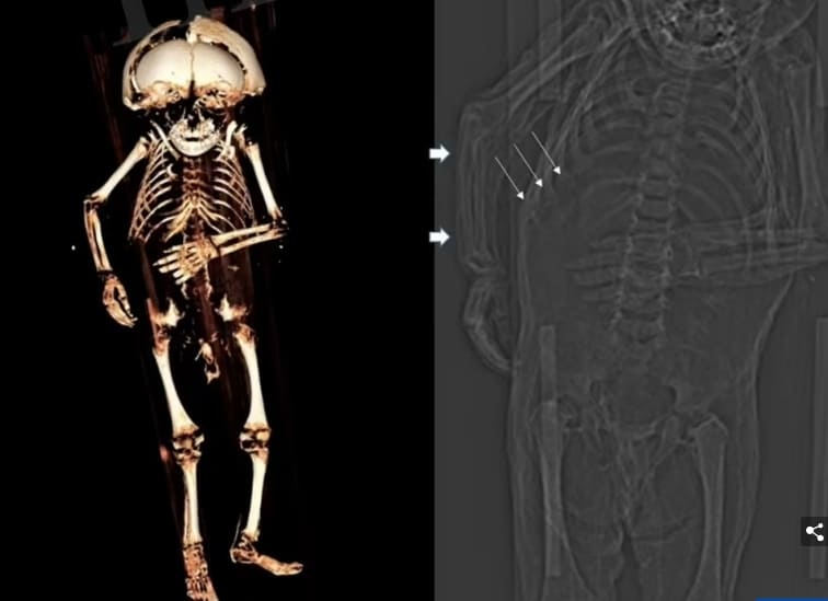 17세기 백작 아들로 밝혀진 미이라 Unravelling the mystery of Austria's mummified TODDLER