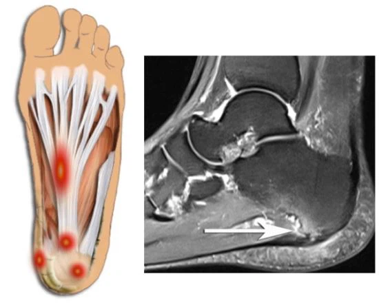 족저근막염