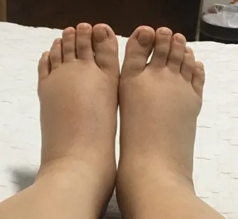 부종의 원인과 증상 5가지 개선방법 치료법_18