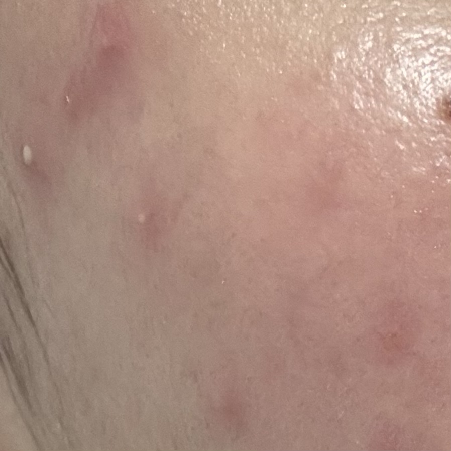 모낭염 염증 구분 사진