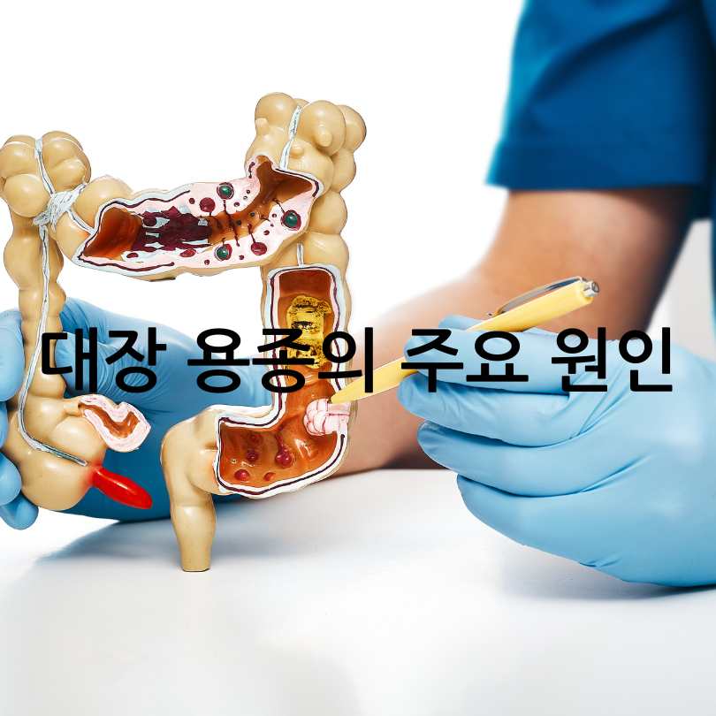 대장 용종과 선종의 차이점부터 예방법