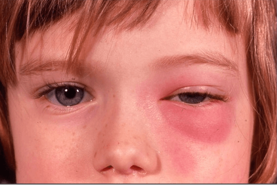 눈-주변에-온-봉와직염