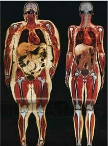 내장지방인과일반인비교