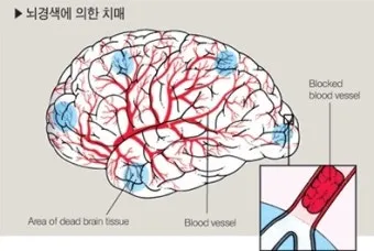 혈관성치매 원인 증상 치료법과 예방 생활습관_17