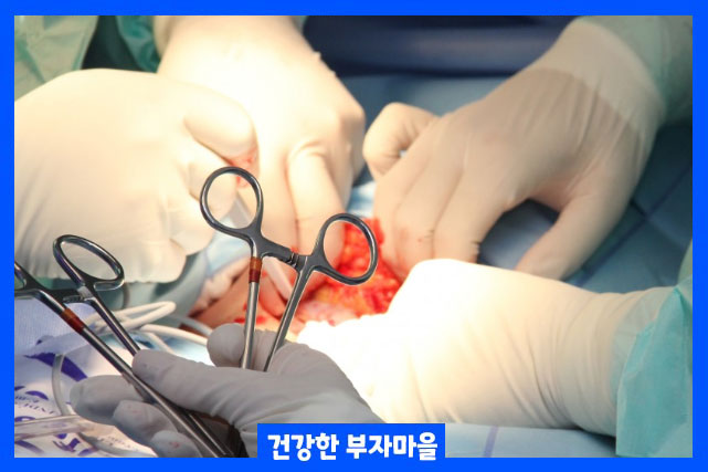 하지정맥류 수술 3가지 유형