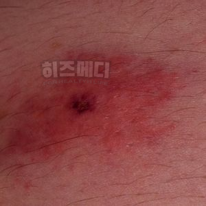 쯔쯔가무시 증상