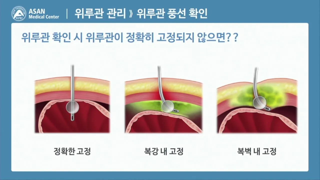 위루관 수술이란 위루술PEG 방법 적응증 부작용 총정리 병원선택_6