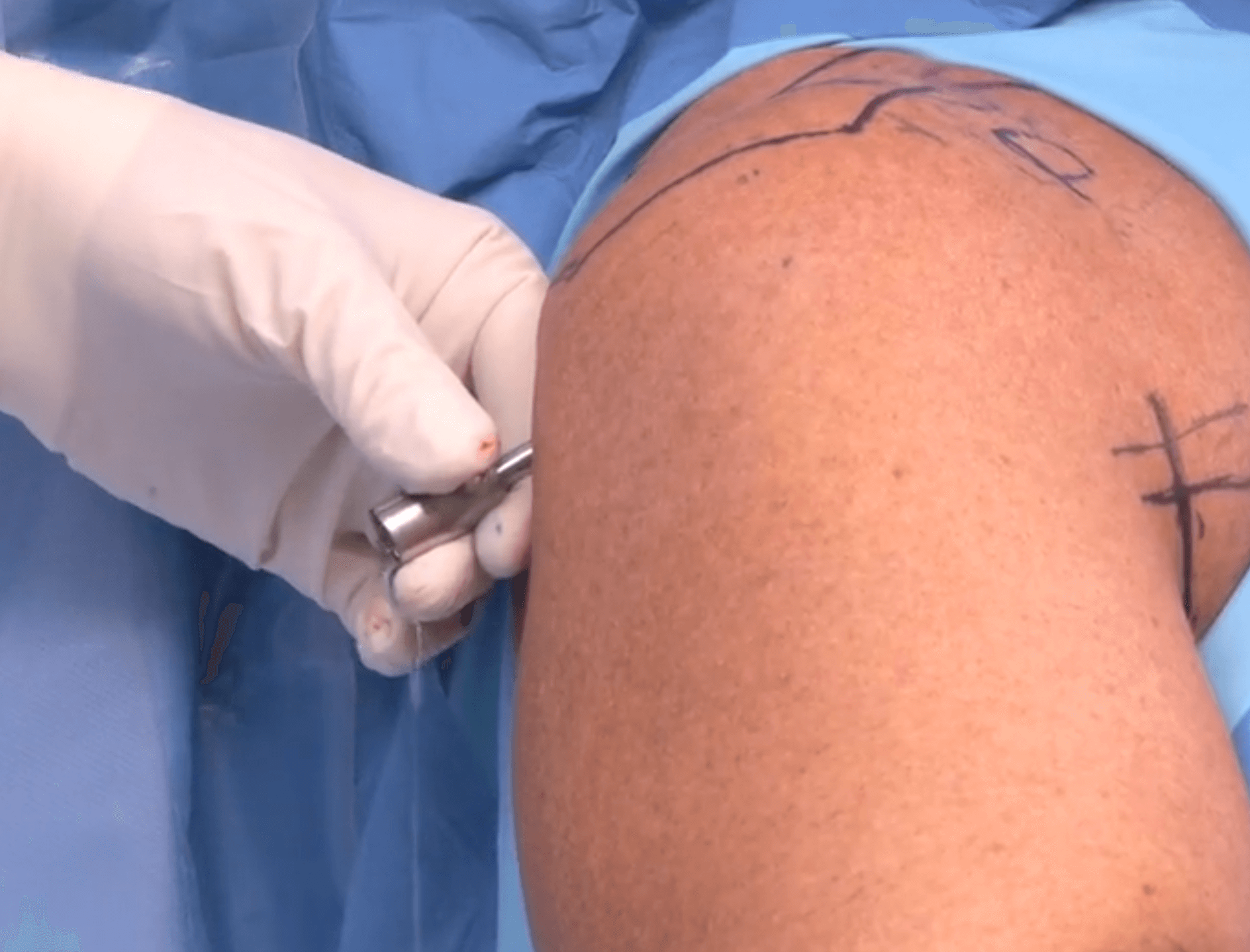 회전근개파열 수술