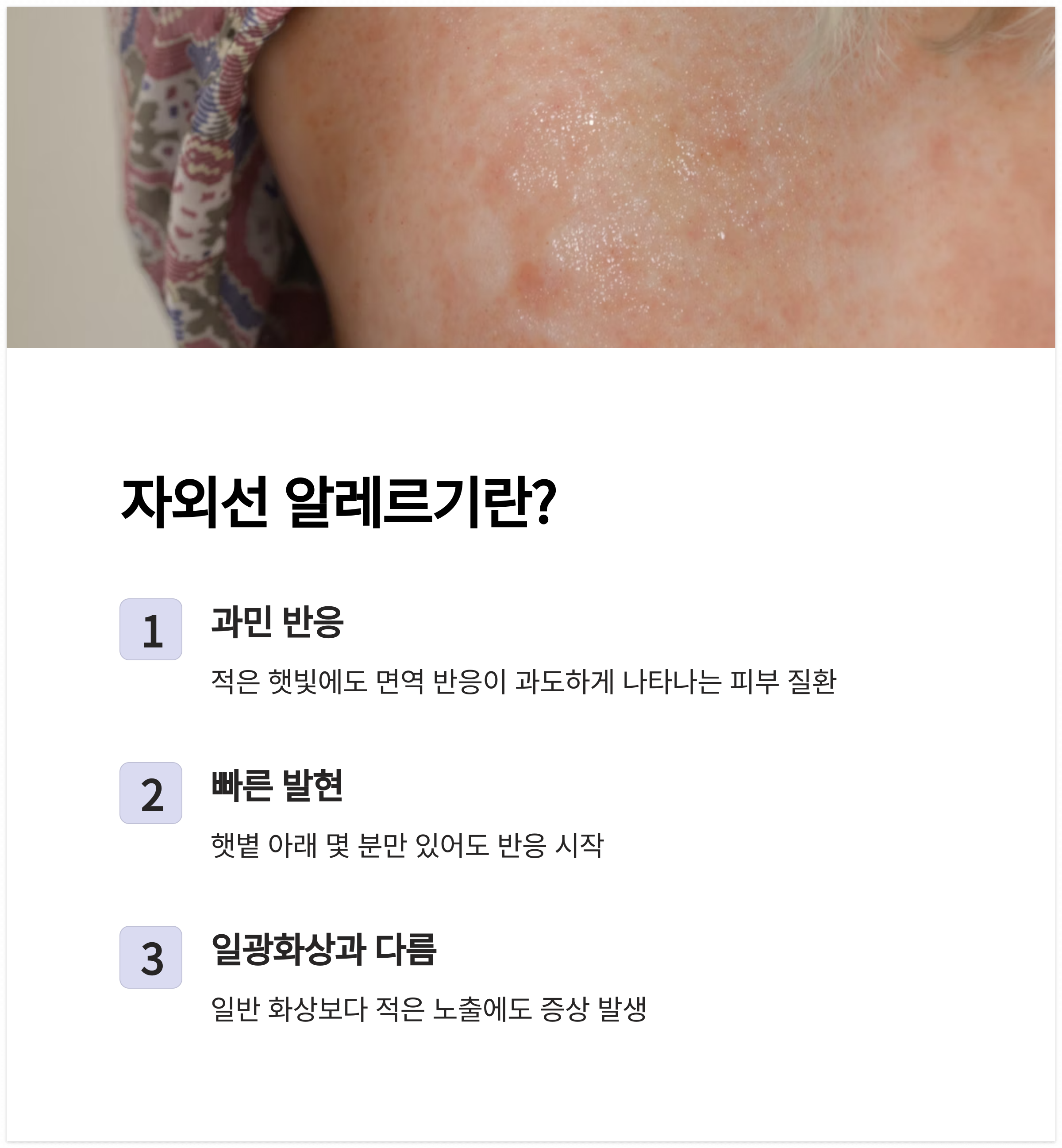 자외선 알레르기란 무엇인가