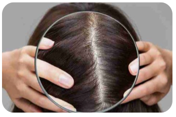 지루성-두피염-증상