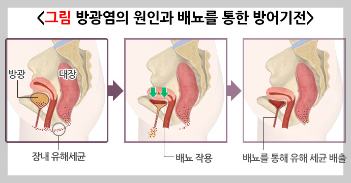 방광염