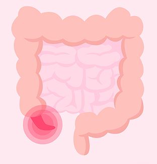 대장의-끝에-맹장염이-있는-이미지