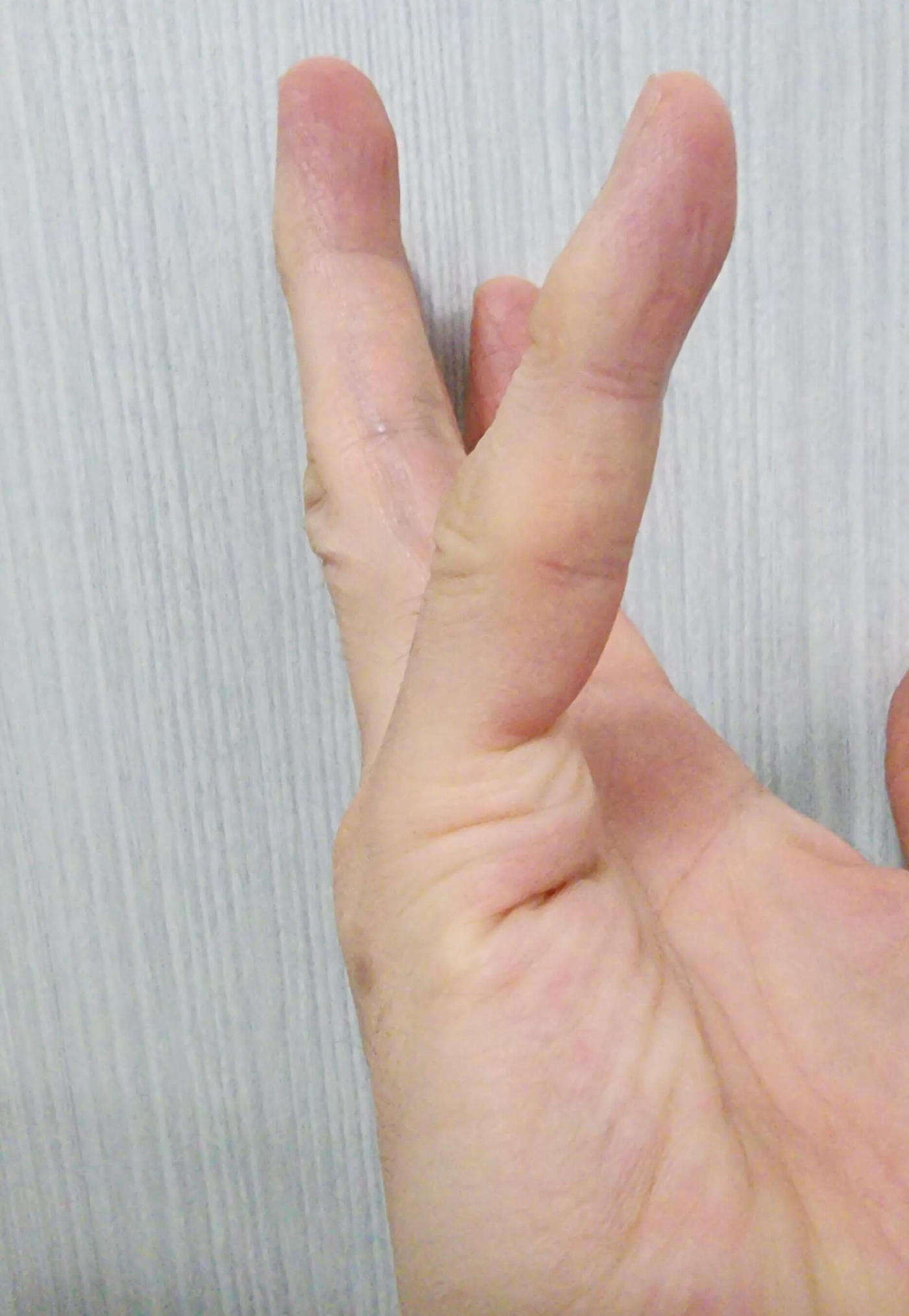 2023년4월현재상태의손가락사진