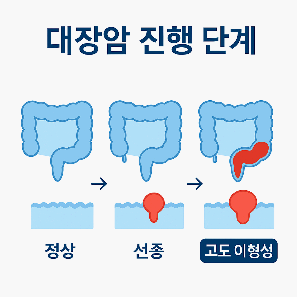 대장용종 대장암