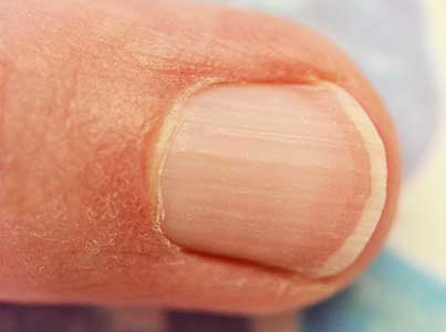 손톱-세로줄-원인