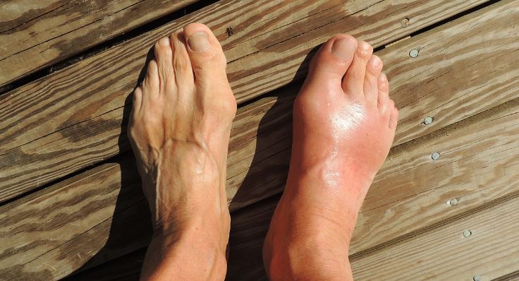 장내 환경이 통풍을 결정한다 &ndash; 퓨린 대사와 요산 배출의 숨겨진 연결고리