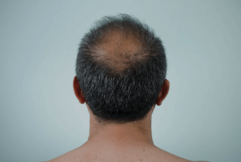 비듬 치료방법