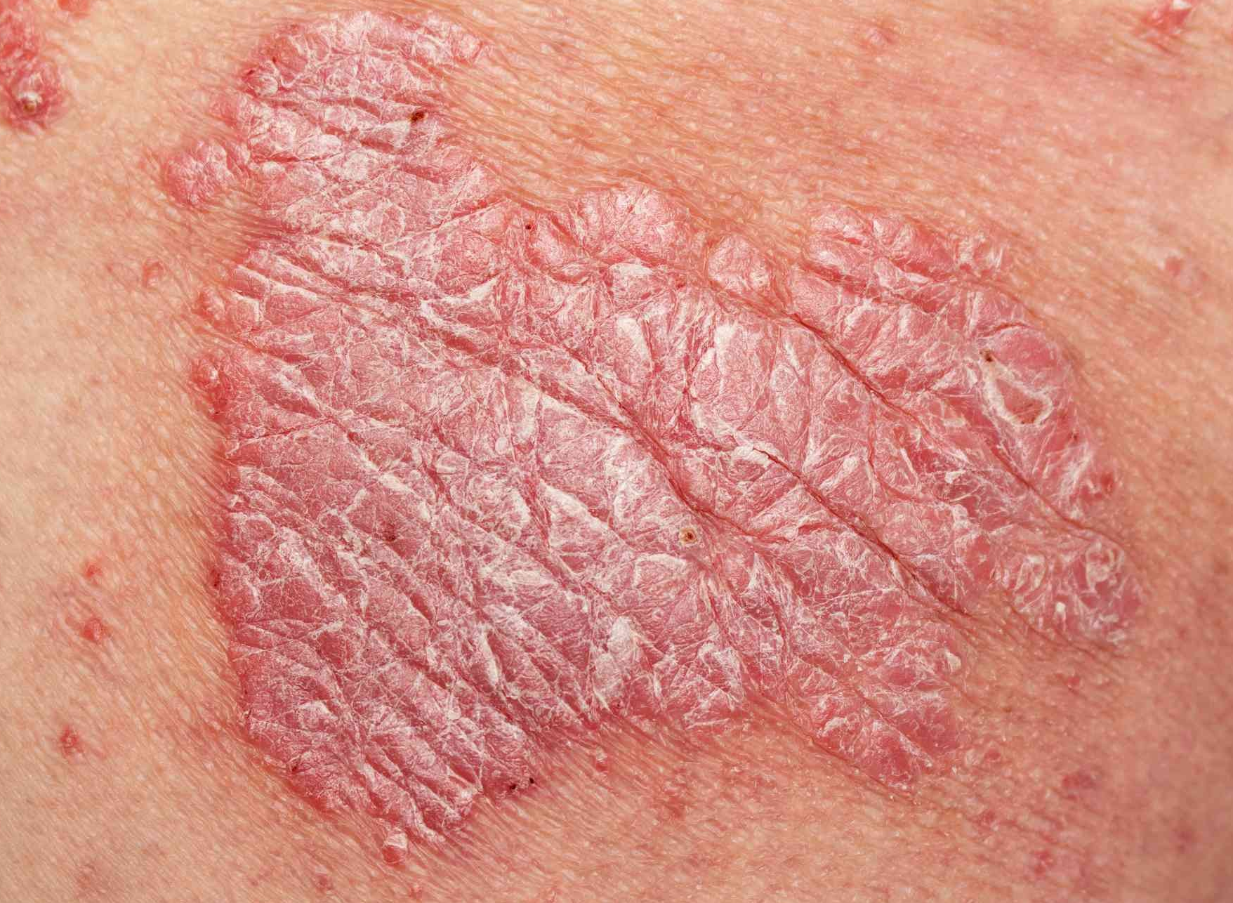 대상 포진과 땀띠: 증상, 원인, 그리고 효과적인 치료법과 예방 전략