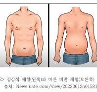 마른비만