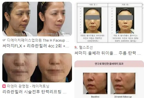 써마지
