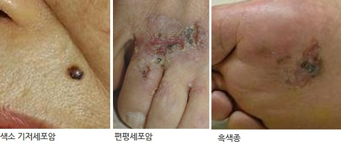 피부암 증상과 원인, 치료까지