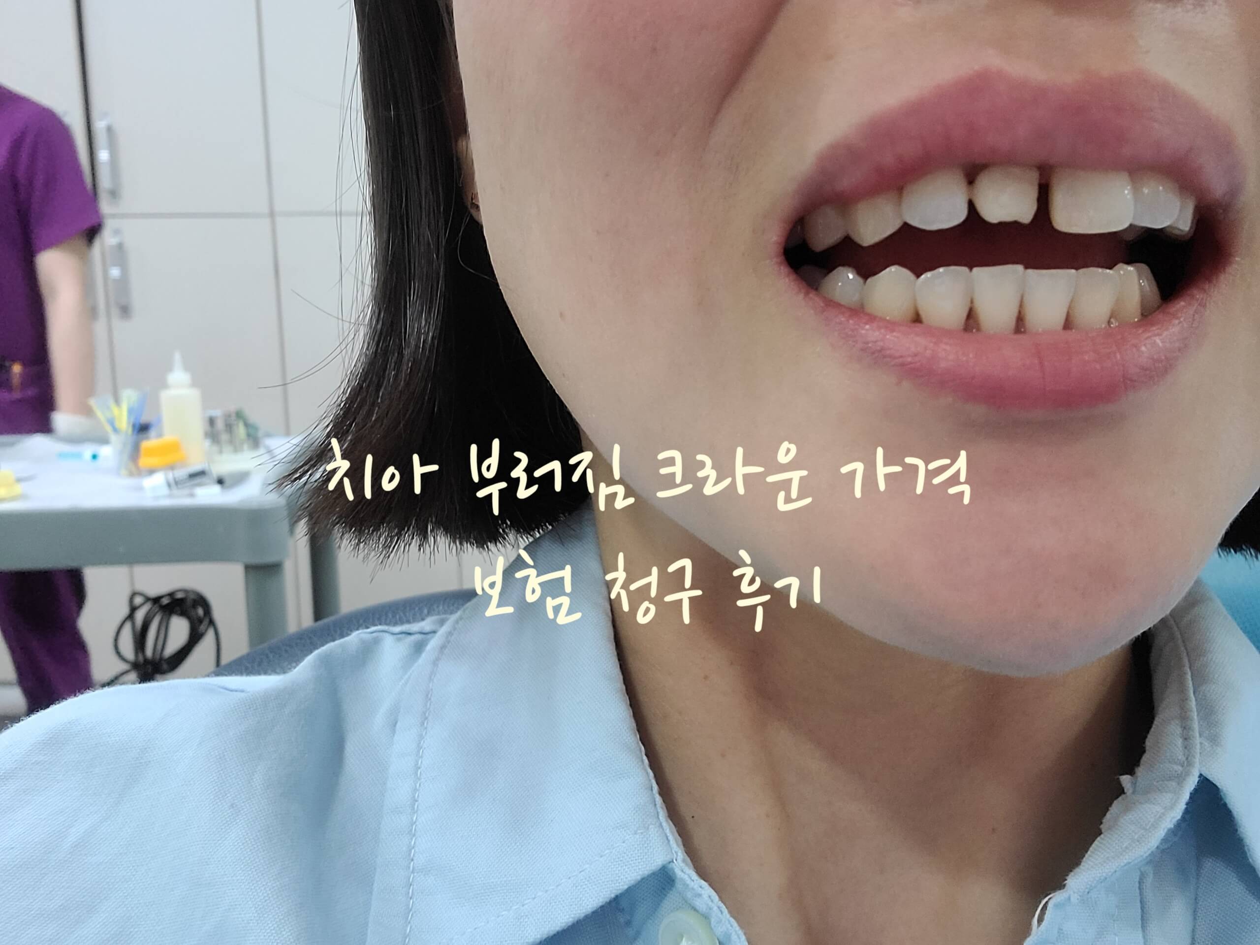치아 부러짐 후기