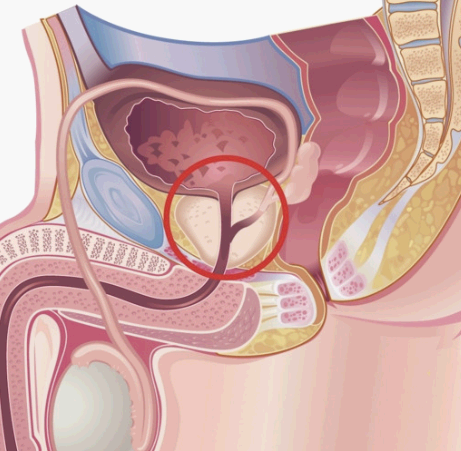 전립샘암 모습