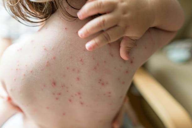 대상포진 예방접종 가격