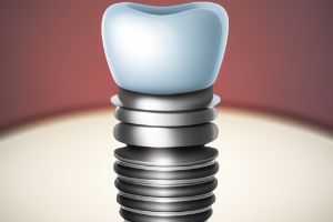 용인시-수지구-임플란트-치과-가격-비용-싼-곳,저렴한-곳,잘하는-곳,유명한-곳-BEST20-추천1