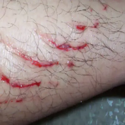 파상풍-예방접종-가격-저렴한-병원찾기-건강