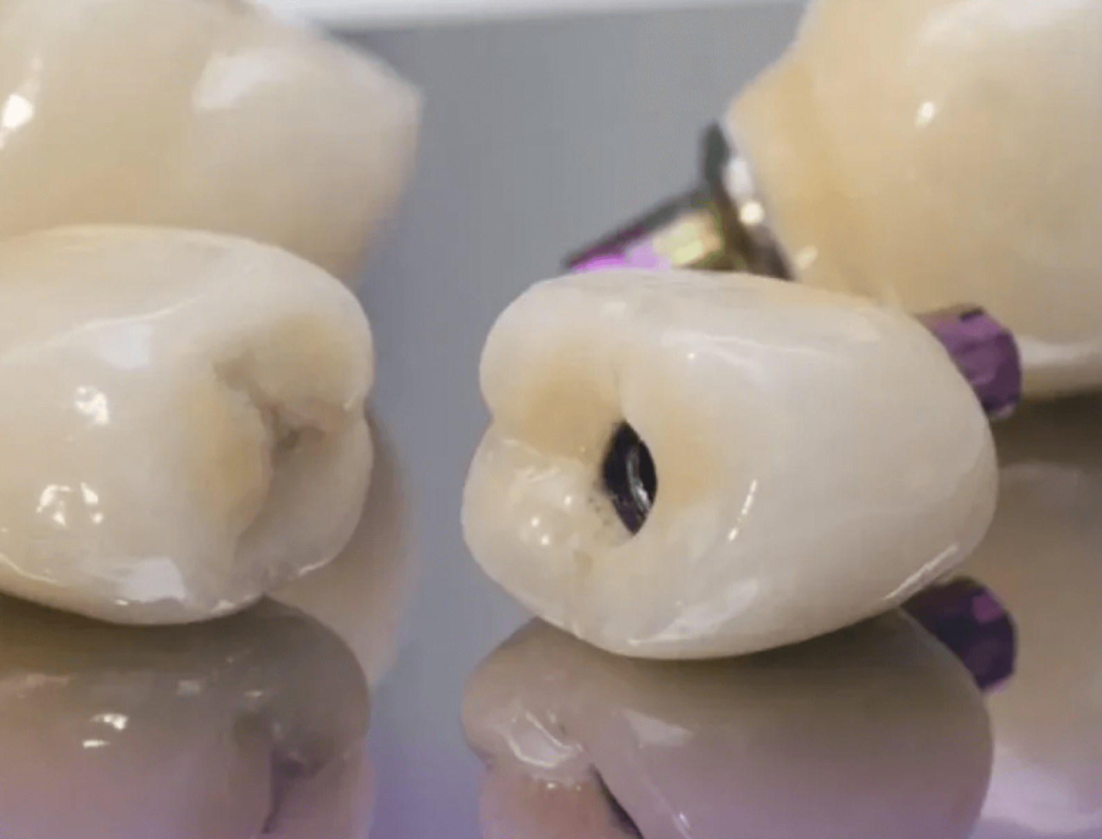 지르코니아 가격