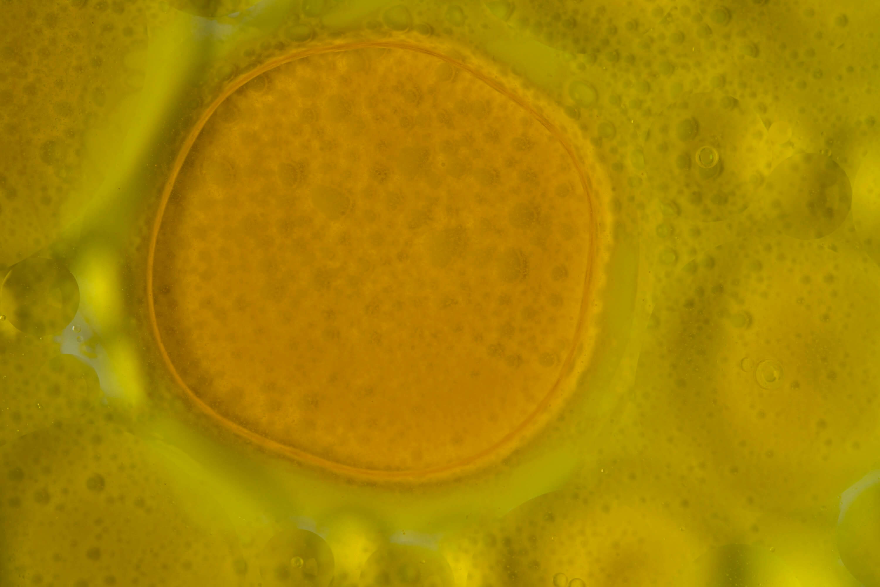 소변에서 피가 나오는 경우