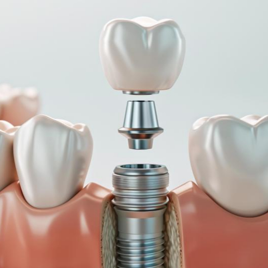 임플란트 시술과정 단계별 설명3