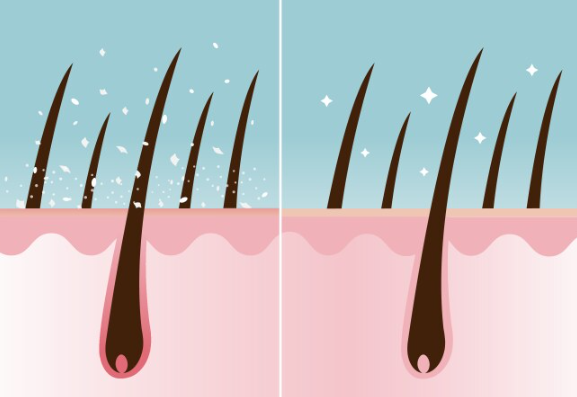지루성두피염 증상 7가지와 의사 인증 확실한 관리법