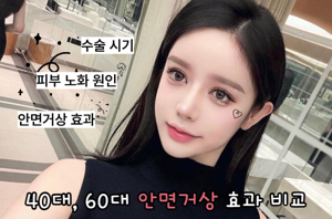 안면거상리프팅