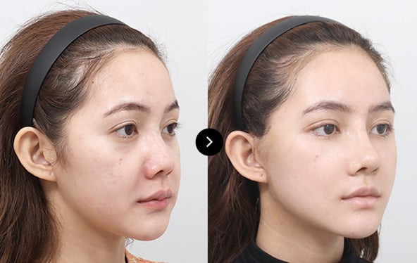  미니 리프팅 상담&middot;시술 가능 클리닉 후기 인지도 높은 곳