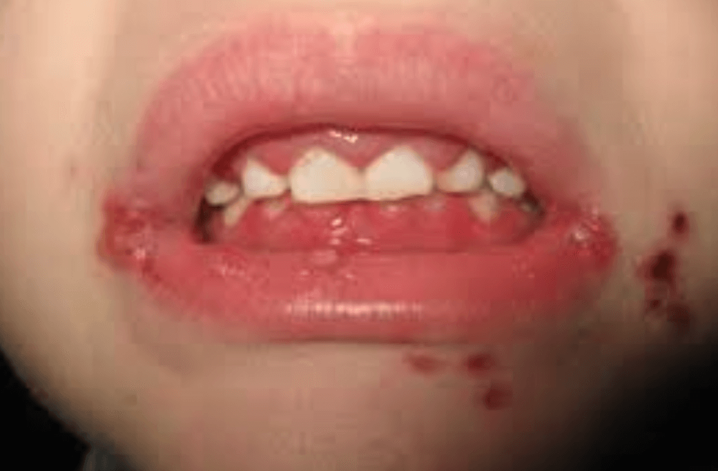 헤르페스성 구내염