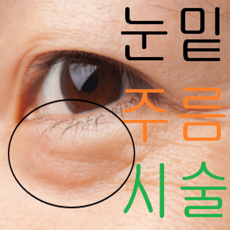 눈밑 주름이 심한 여성
