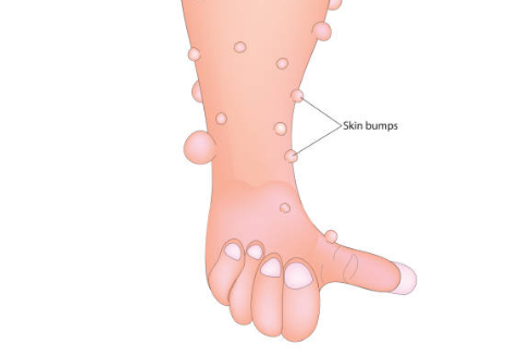 쥐젖 제거방법, 쥐젖이 생기는 이유, 제거 연고 총정리 (2024ver)