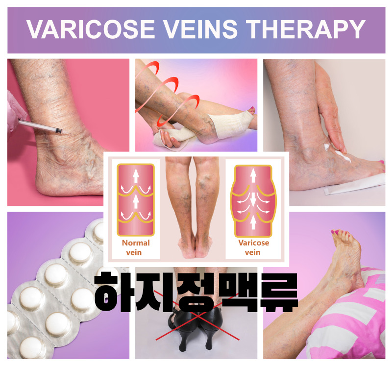하지정맥류