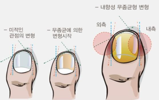 발톱 무좀 증상