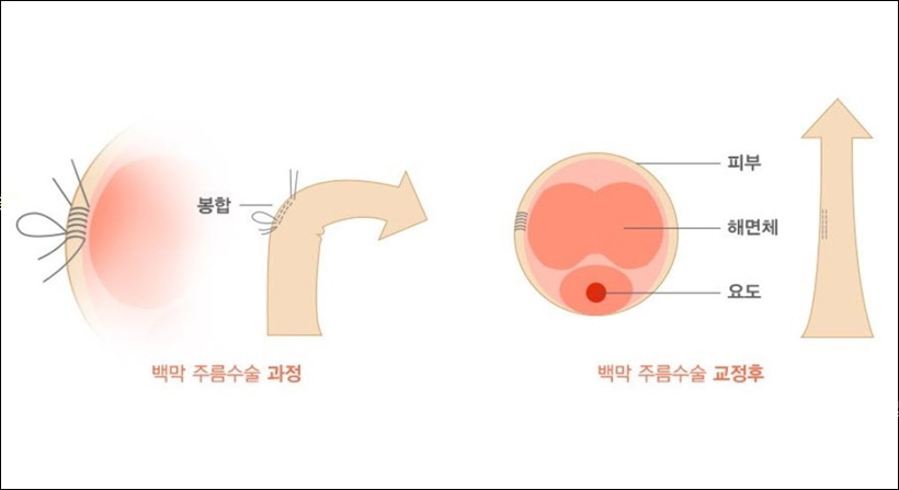 페이로니병 수술