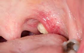 편도염 빨리 낫는법